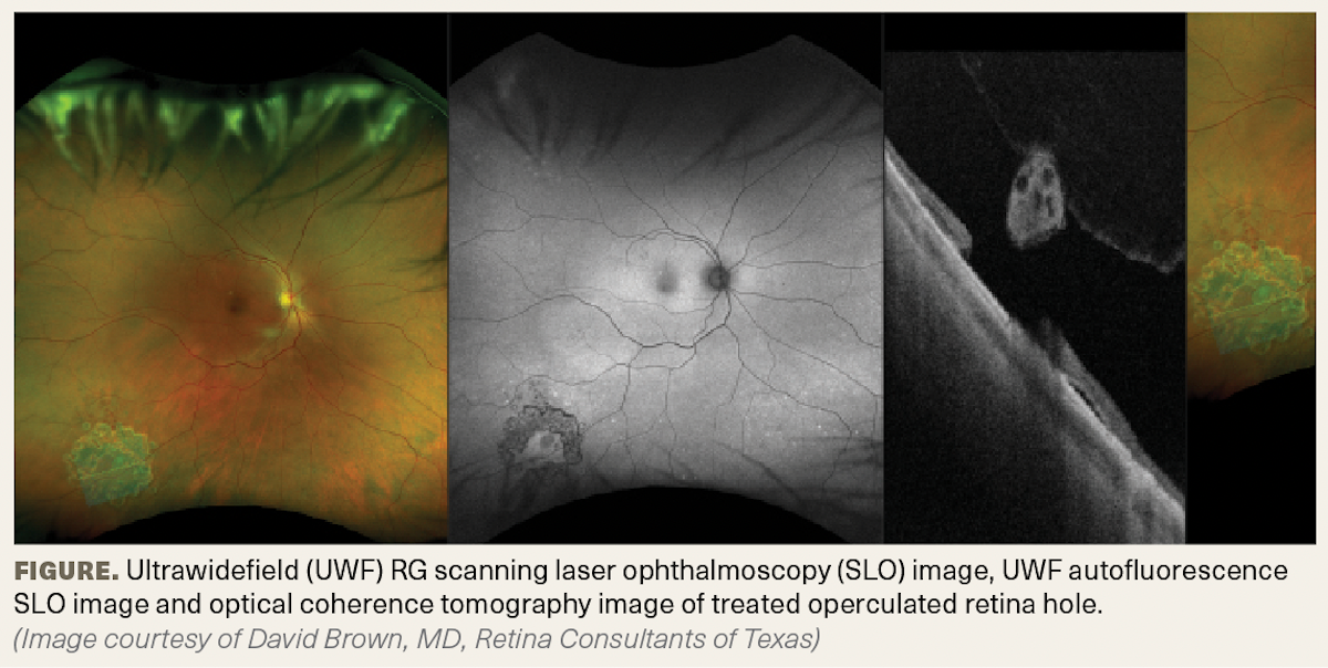 Ultrawidefield (UWF) RG scanning laser ophthalmoscopy (SLO) image, UWF autofluorescence SLO image and optical coherence tomography image of treated operculated retina hole. (Image courtesy of David Brown, MD, Retina Consultants of Texas)