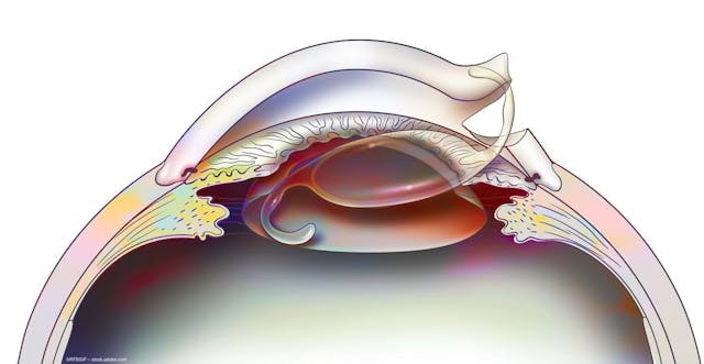 An illustration of an intraocular lens being inserted into the eye. Image credit: ©RFBSIP – stock.adobe.com