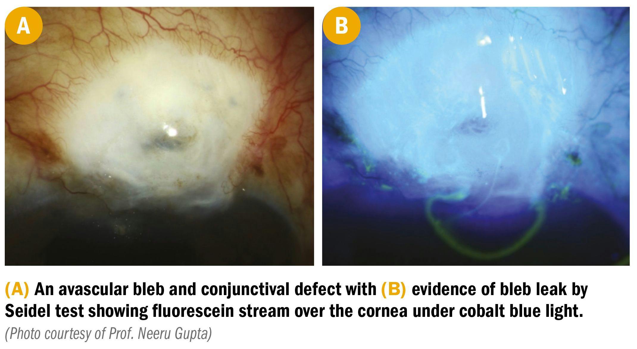 scans of avascular bleb and conjunctival defect of eye