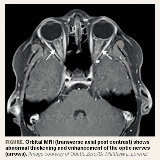 Making the diagnosis: Bilateral blurry vision in a 9-year-old boy