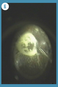 Figure 6. Vitreous attachment through the oval defect in posterior vitreous cortex observed during PVD creation in vitreous surgery. After core vitrectomy, artificial posterior vitreous detachment is created using triamcinolone. The vitreous gel adhesion to the macula through the oval defect in the posterior vitreous cortex is clearly seen. (All images courtesy of Dr Akihiro Kakehashi)