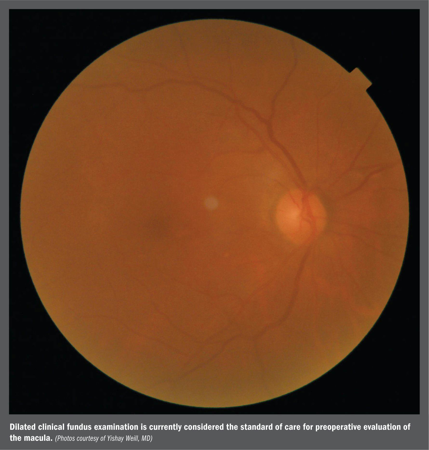Macular OCT assists preop cataract surgery evaluation