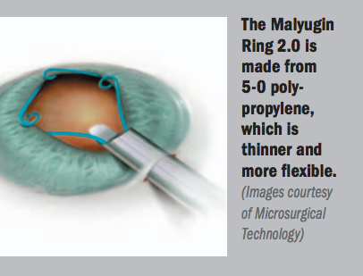 Next-generation device helpful in managing inadequate pupil dilation