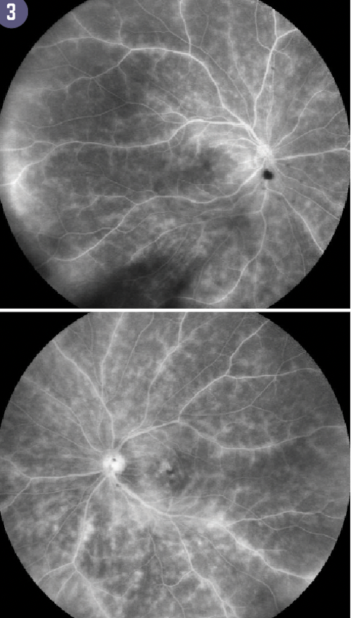 Figure 3 shows Fluorescein angiography demonstrates diffuse “ferning” small vessel vasculitis from the disc to the periphery in both eyes.