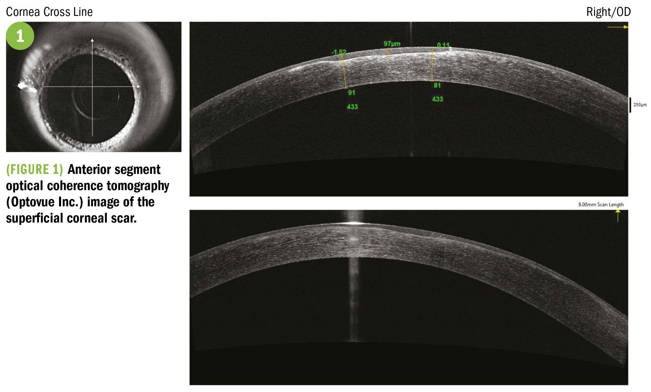 Image of superficial corneal scar through optical coherence tomography