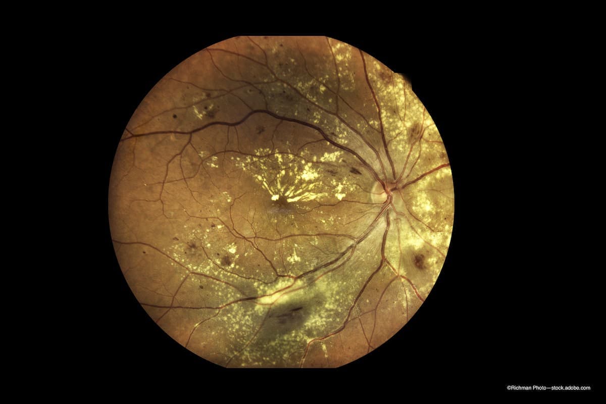 Repeatable, high-quality imaging leads to better diabetic eye disease management