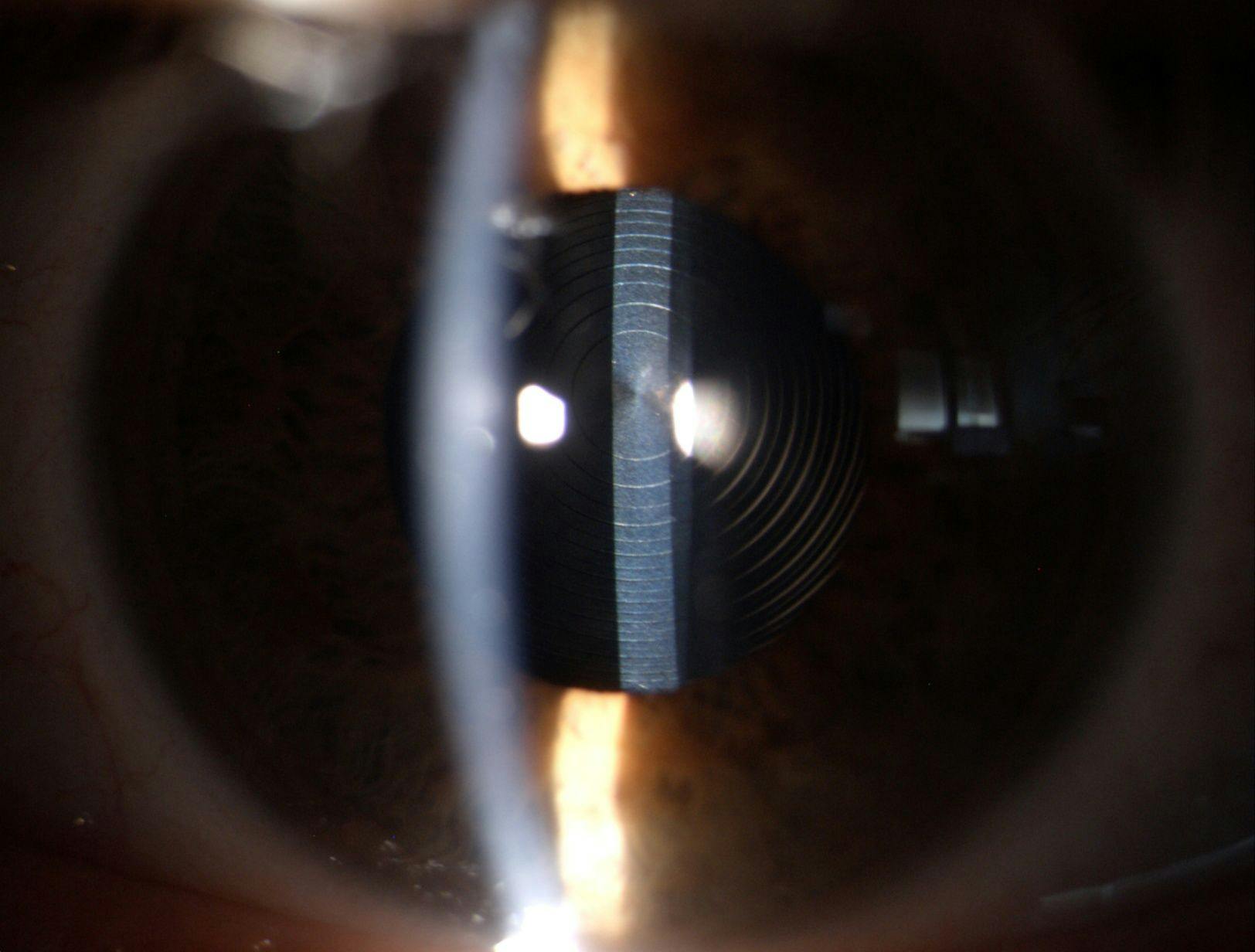 Figure 2: Slit-lamp examination at 3 months postoperatively showed the IOLs were well-centered