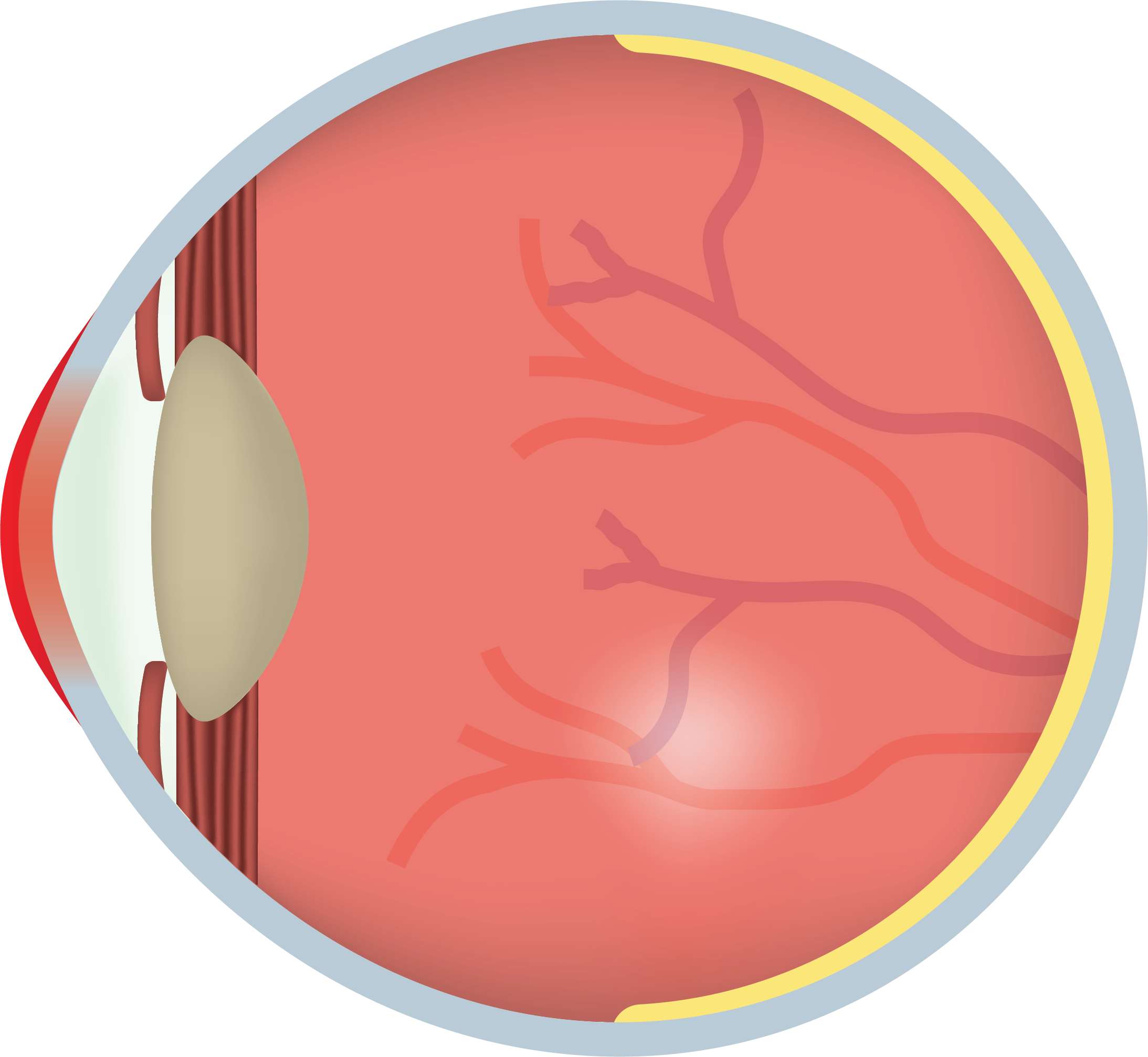Illustration showing dry eye