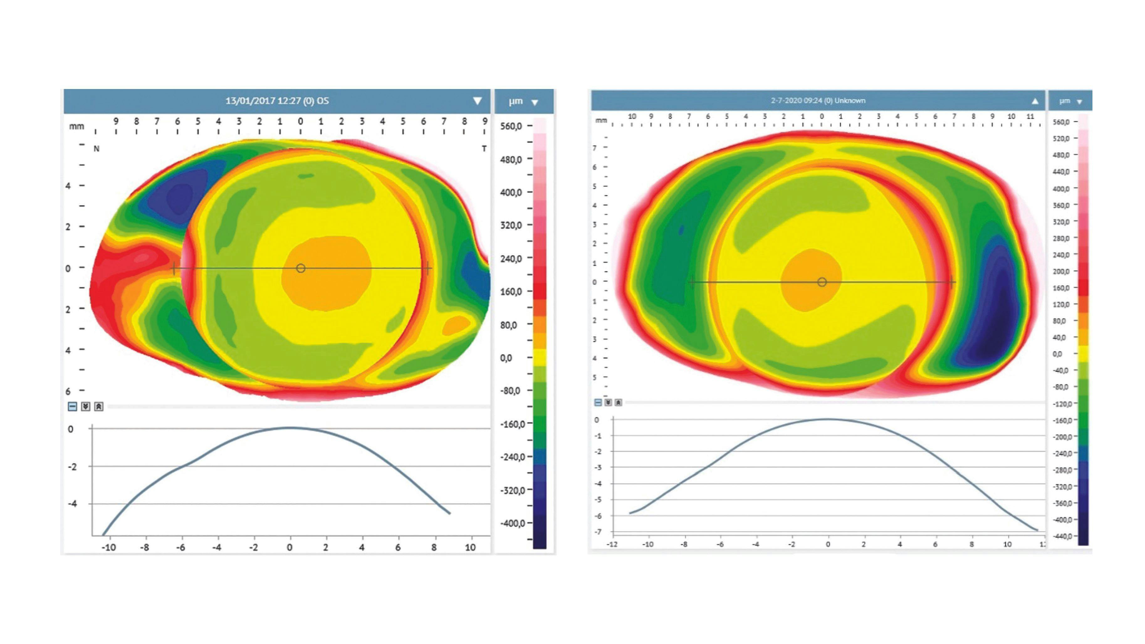 Bi-sphere corneo-scleral topographic map obtained in an emmetropic eye (left) and a myopic eye (right). (Figure courtesy of Dr Laurent Bataille, Dr Ainhoa Molina-Martín and Dr David P. Piñero)