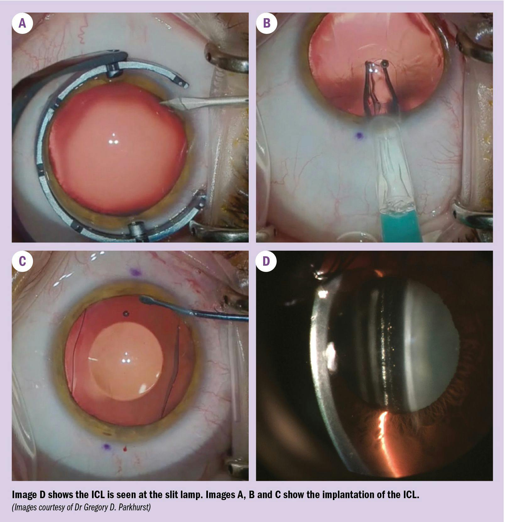 Image D shows the ICL is seen at the slit lamp.  Images A, B and C show the implantation of the ICL. 