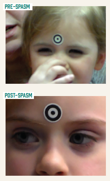Figure 1. A young patient is shown before a spasm and after an achromatopsia episode. (Images courtesy of Dr Richard W. Hertle)
